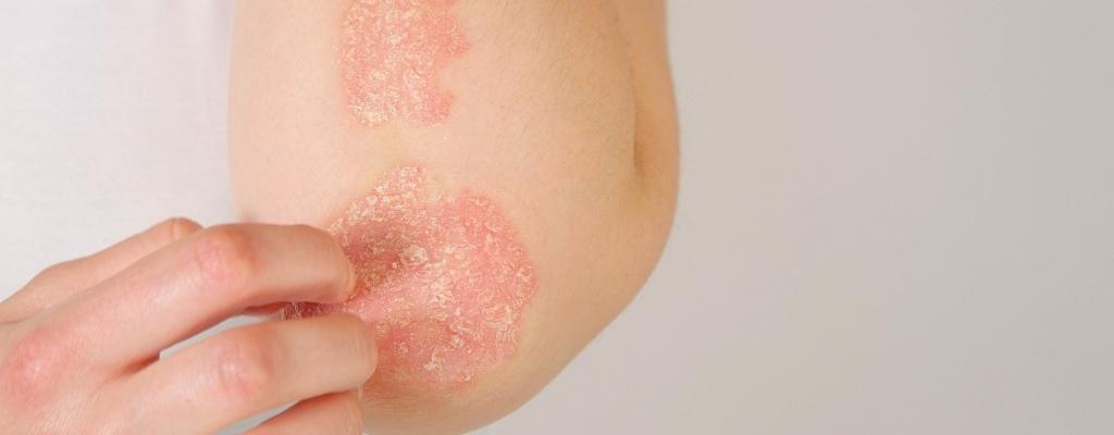 blog ¿Qué es la psoriasis? Tratamiento y cuidados de la piel