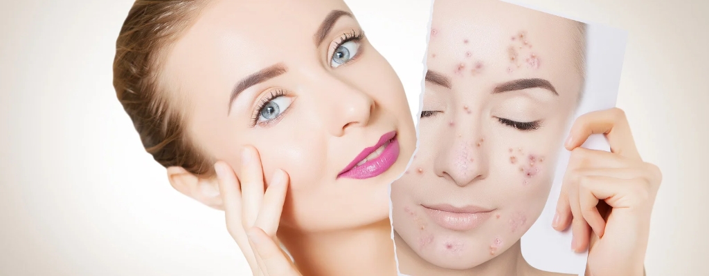 blog Descubre el ácido azelaico y sus beneficios