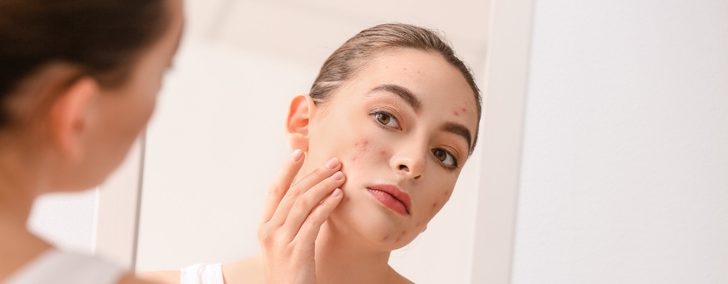 blog Cómo cuidar las pieles acneicas