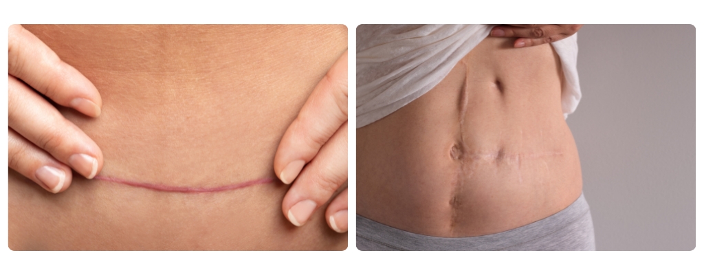 Cuidado de las Cicatrices: Productos que realmente ayudan a su regeneración
