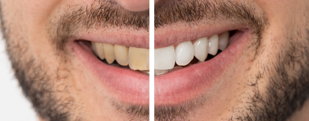 blog Blanqueamiento dental: Cómo conseguir unos dientes más blancos de forma segura y efectiva